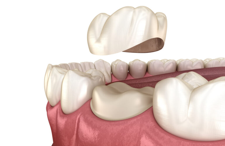 crown and bridges-holy dental care services in south mumbai