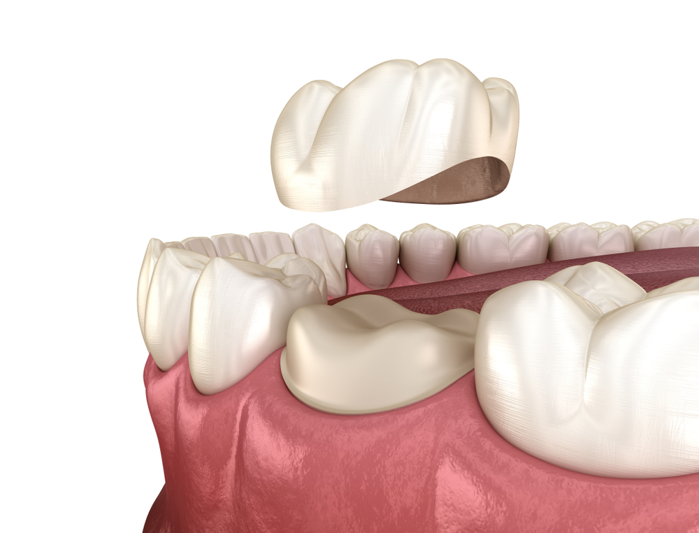 crown and bridges-holy dental care services in south mumbai