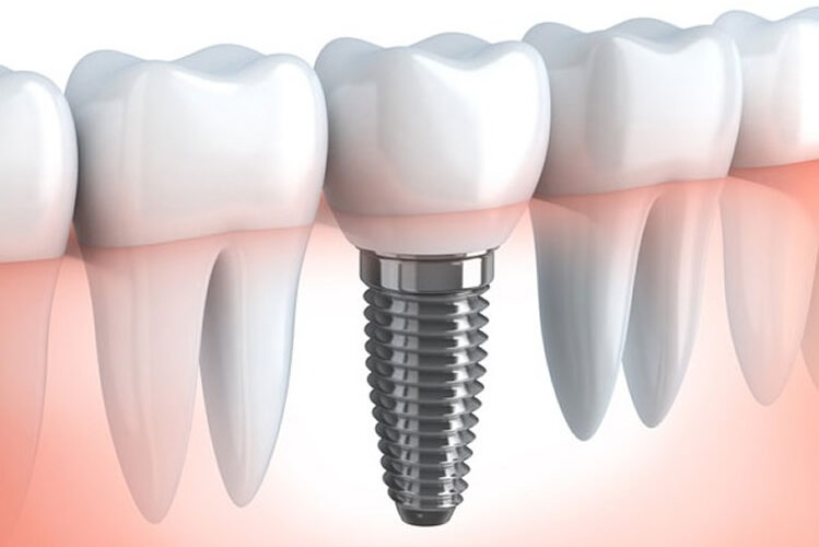 dental implant treatment at dr moin holy dental care south mumbai