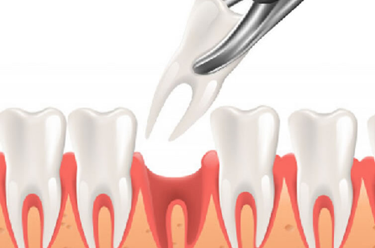 tooth extraction at dr moin holy dental care south mumbai