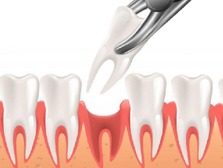 tooth extraction at dr moin holy dental care south mumbai