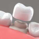 dental crown and bridges treatment at dr moin holy dental care clinic south mumbai