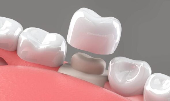 dental crown and bridges treatment at dr moin holy dental care clinic south mumbai