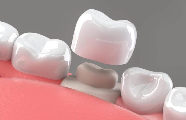 dental crown and bridges treatment at dr moin holy dental care clinic south mumbai